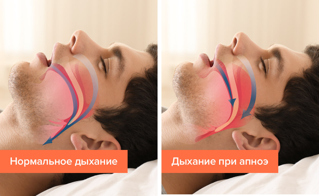 Апноэ