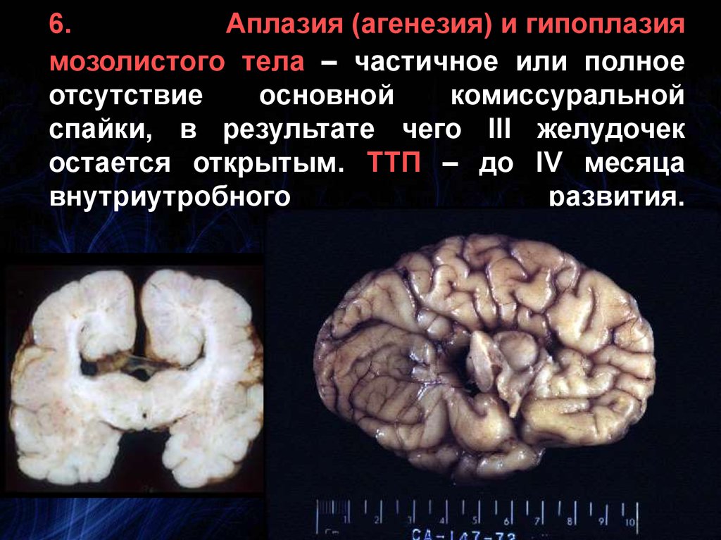 Гипоплазия мозолистого тела