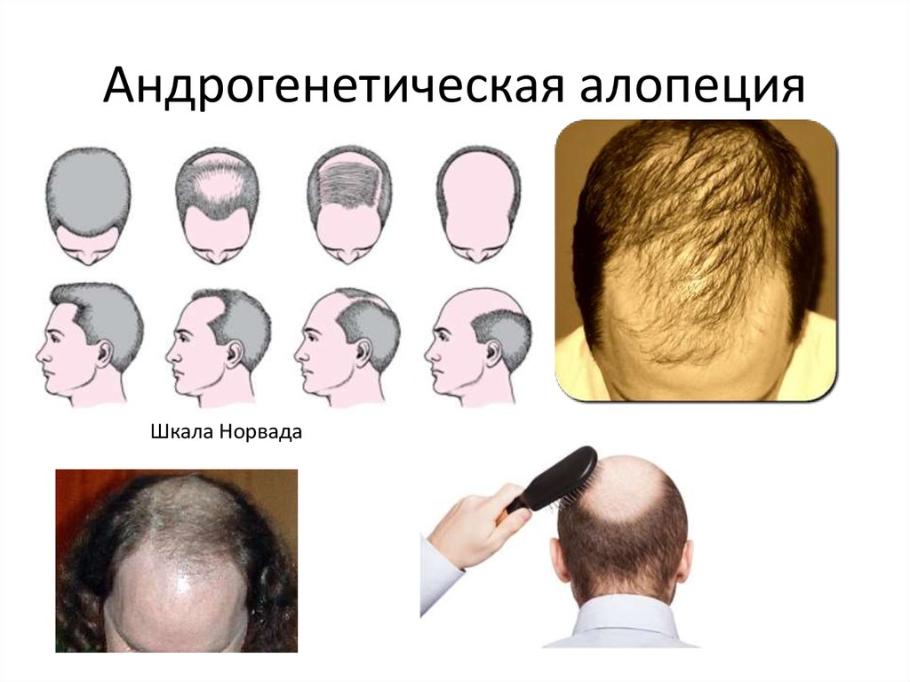 алопеция