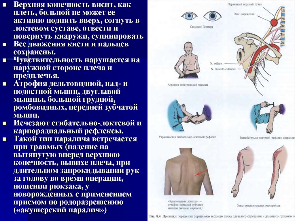 симптомы паралича дюшена эрба
