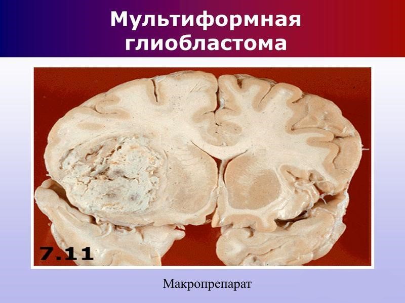 Мультиформная глиобластома
