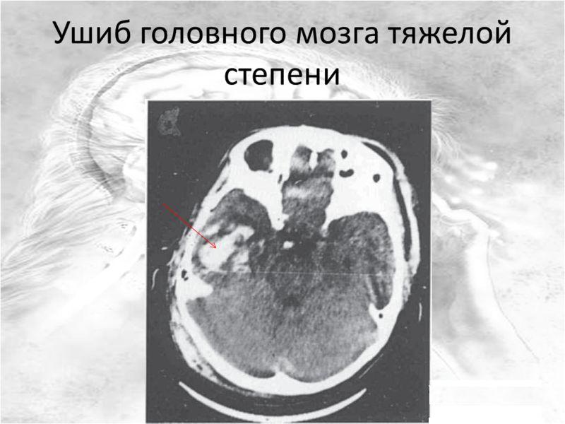 Ушиб тяжелой степени