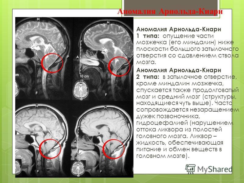 1 и 2 тип аномалии Арнольда Киари