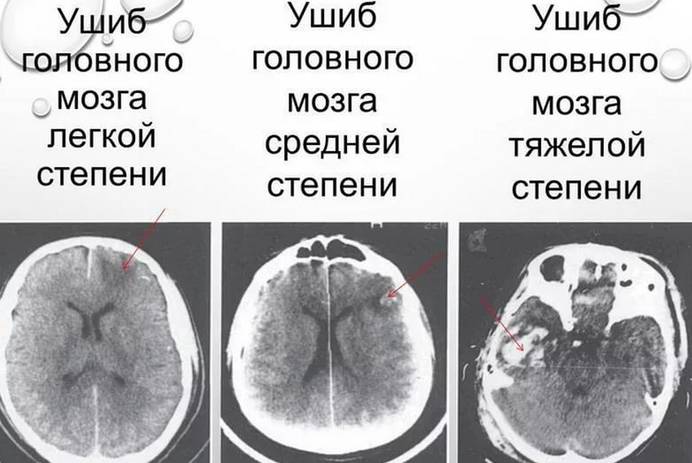 Степени сотрясений головного мозга