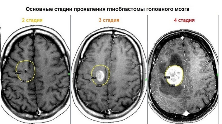 Стадии опухоли головного мозга