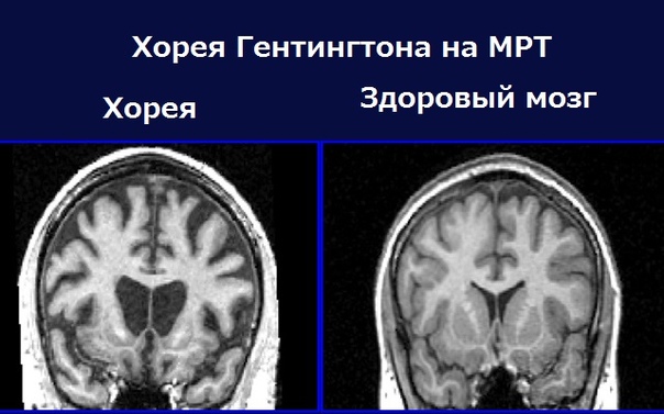 мрт