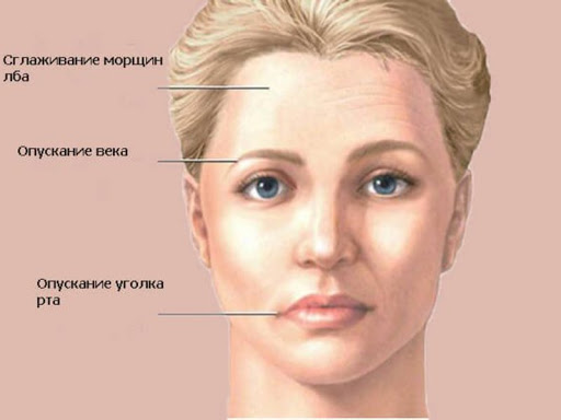 воспаление Женщина тройничного лица нерва
