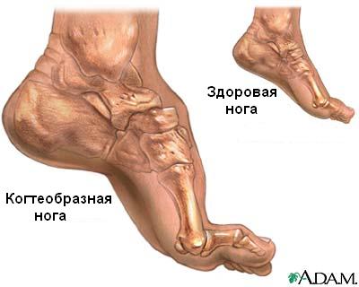 Заболевание Шарко Мари-Тута