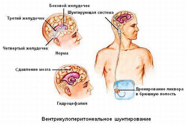 шунтирование