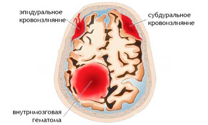 Классификация кровоизлияний