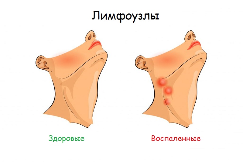 воспаленные лимфоузлы