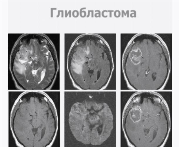 Глиобластома головного мозга