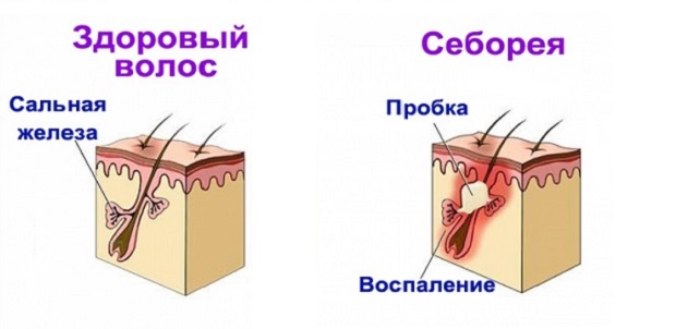 здоровый волос и себорея