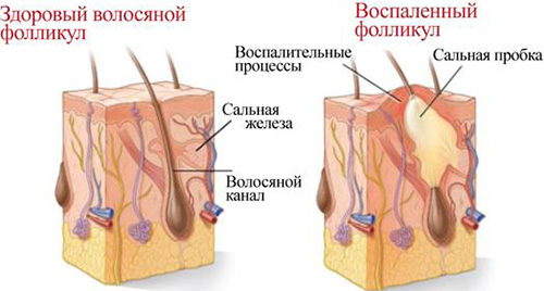 здоровый и воспаленный фолликул