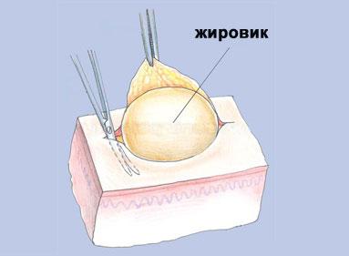 жировик