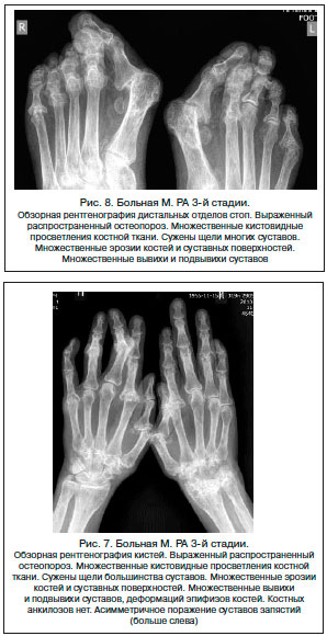 III стадия артрита