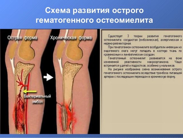 причины и патогенез остеомиелита Патогенез остеомиелита