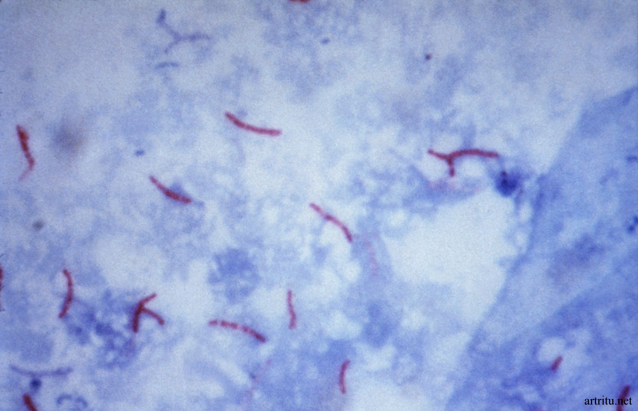 M.tuberculosis Отдельные виды инфекционных артритов