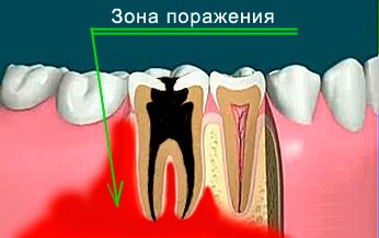 Одонтогенный остеомиелит челюстей