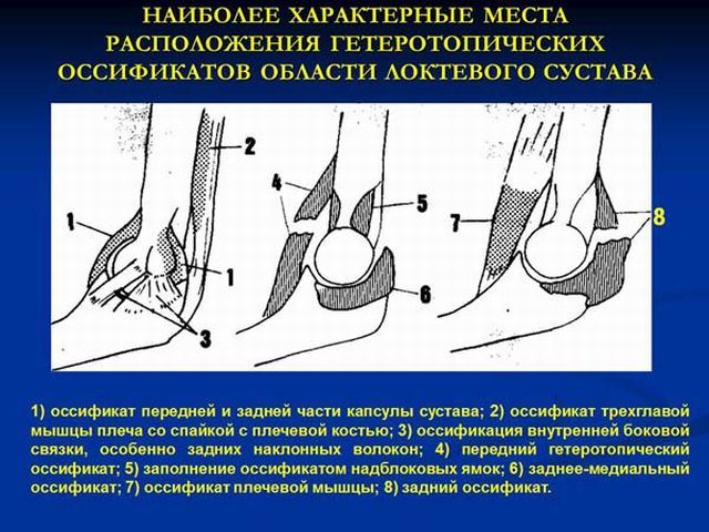 локтовой сустав оссификаты локтового сустава