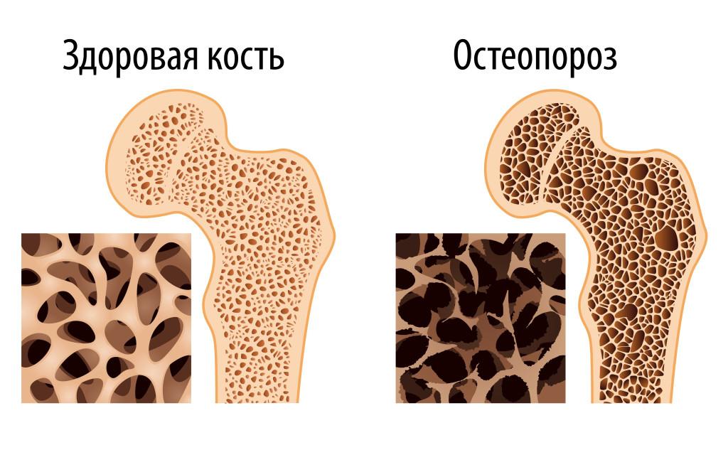 терапия остеопороза у детей
