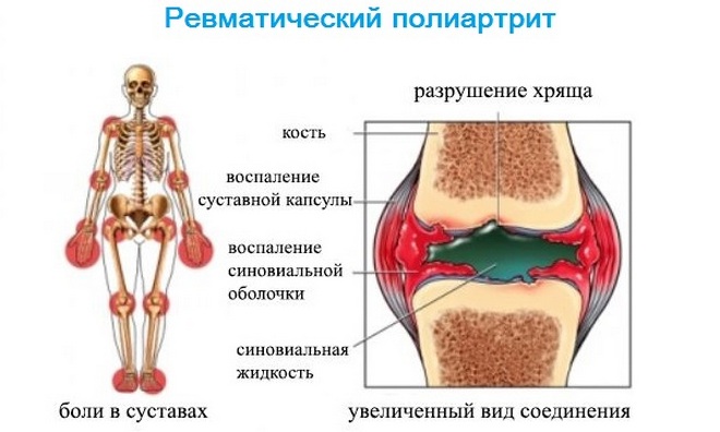 ревматический полиартрит - симптомы Симптомы ревматического полиартрита
