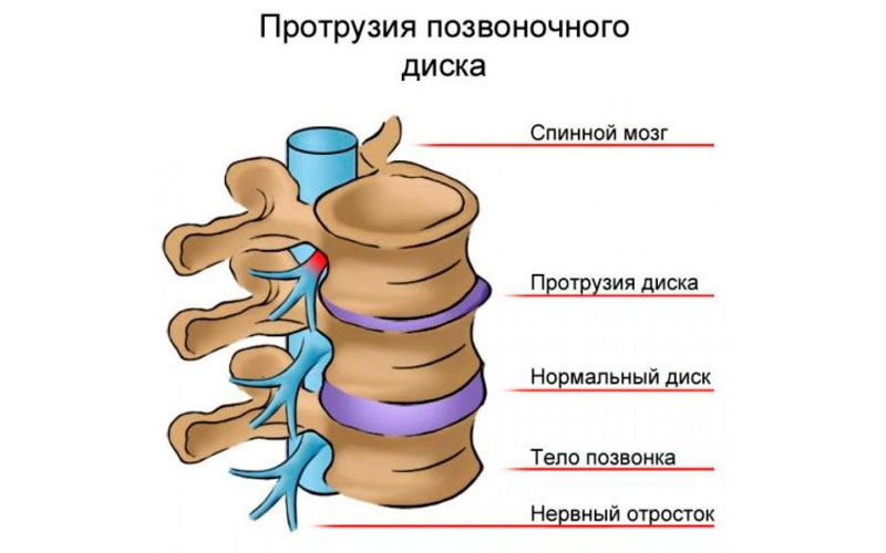 Протрузия диска поясничного отдела
