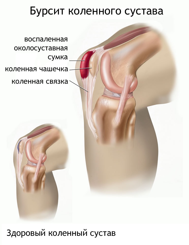 Бурсит коленного сустава