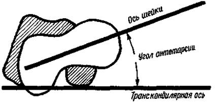 антеторсия антеторсия суставов