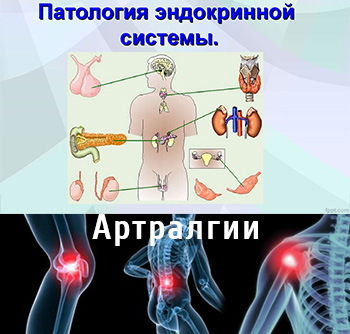 Артралгия при эндокринной патологии