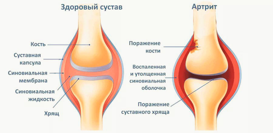 артрит коленного сустава