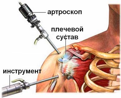Ротаторная манжета плечевого сустава: симптомы травмы, повреждения Артроскопия