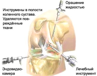 артроскопия