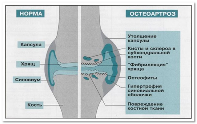 Артроз межфаланговых суставов стопы и кистей рук
