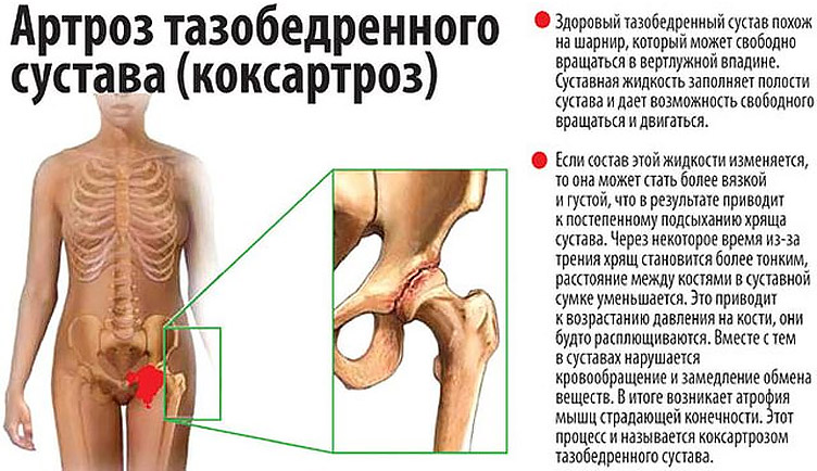 Артроз тазобедренных суставов