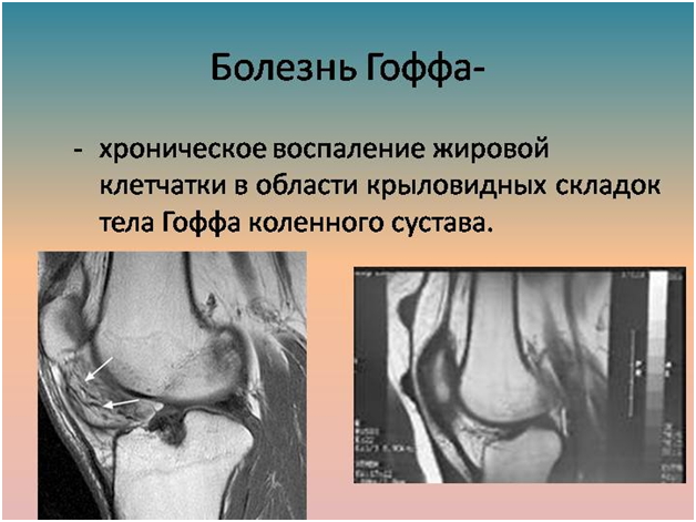 болезнь Гоффа