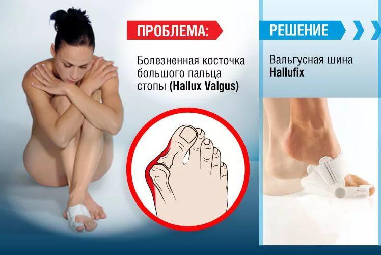 Болезненная косточка большого пальца стопы