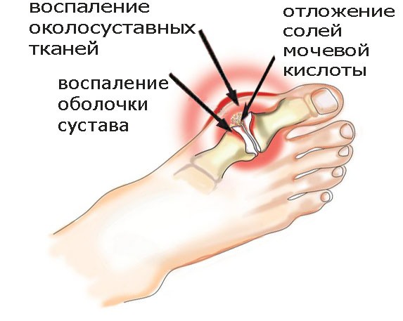 Больной сустав