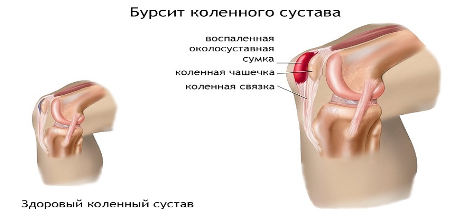 Бурсит коленного сустава