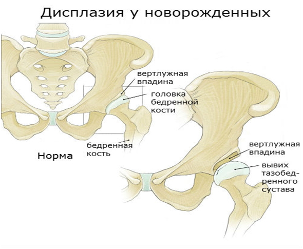 Дисплазия у новорожденных