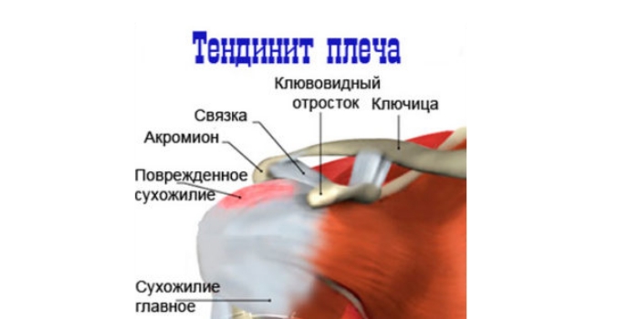 Тендинит