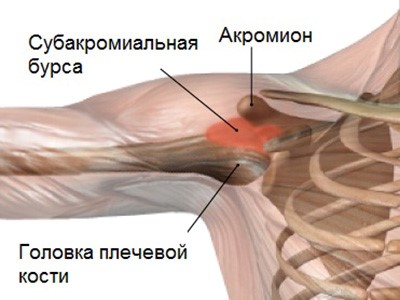 Бурсит