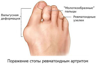 Эрозивный артрит стопы