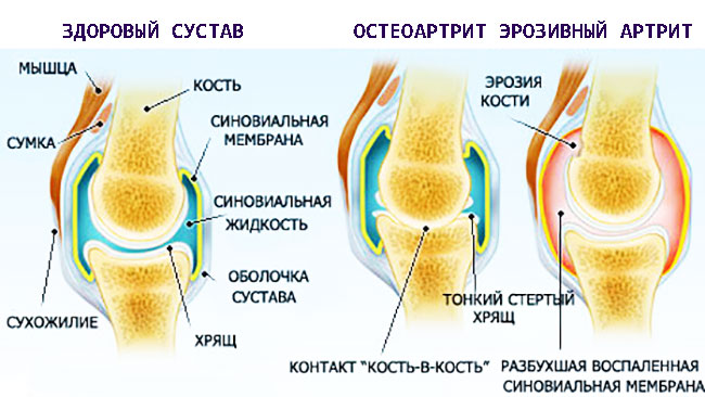Эрозивный артрит