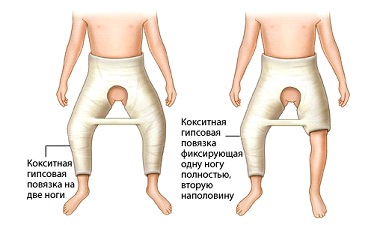 Кокситная повязка
