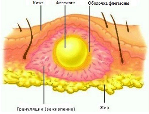 флегмона Инфекционные осложнения артрита - флегмоны