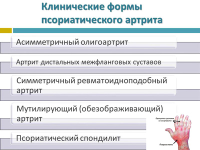 Формы псориатического артрита у детей
