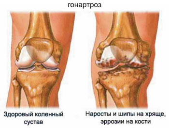Гонартроз