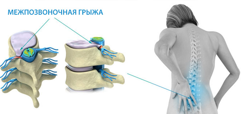 Диафлекс: инструкция, противопоказания, цены, аналоги Гыжа позвонка