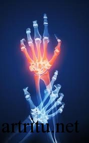 infectious -arthritis3 Виды инфекционных артритов